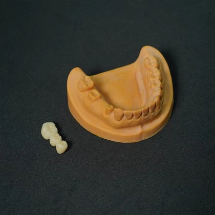 코발트-크롬 합금 도자기 크라운