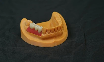 지르코니아 브릿지 임플란트